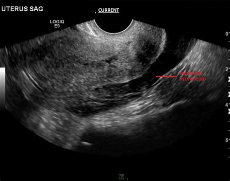 Radiology Case Of The Month Right Adnexal Ectopic Gestation