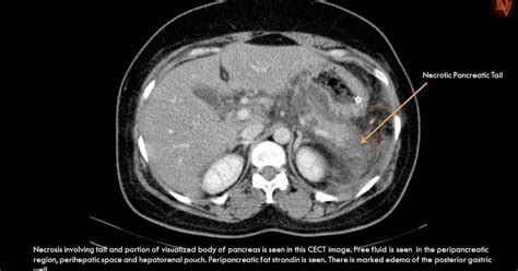 Ultimate Radiology : Acute Necrotizing Pancreatitis