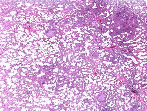 Tuberculosis Lungs Histology