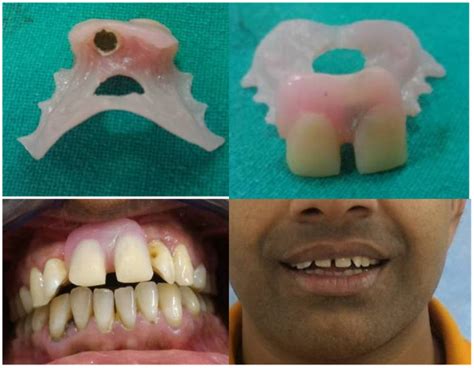 Implant Supported Removable Partial Denture