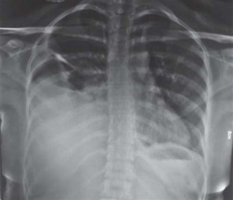 Chest Radiograph Postero Anterior View Showing Rightsided Moderate