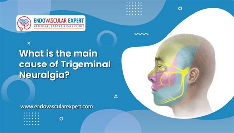 What is the main cause of Trigeminal Neuralgia? - Signs and Symptoms