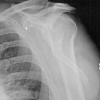 x Ray showing an angulated fracture of the body of scapula. | Download ...