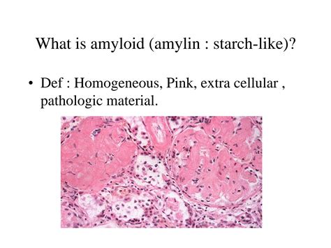 Solution Amyloidosis Studypool