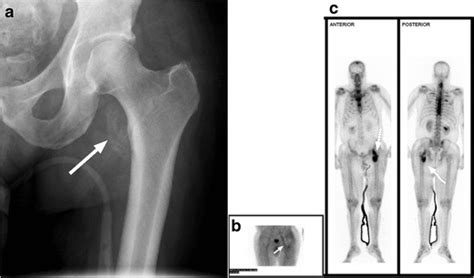 9 Heterotopic Ossification A Hip Radiograph Of A 46 Year Old Male 3 Download Scientific