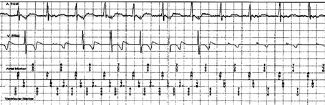 Stored Intracardiac Electrogram Egm Of The Patient In Emergency Room