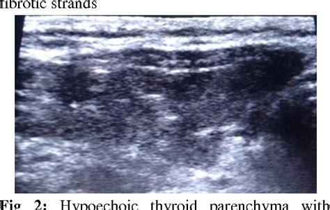 Figure 1 From Diagnosis Of Lymphocytic Thyroiditis Based On Grey Scale Evaluation In Correlation