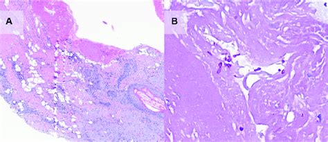 Dermatopathology Findings Of Deep Cutaneous Candidiasis Of The Lip A