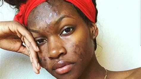 4 Fastest Way To Get Rid Of Pimples Acne Causes And Simple Home