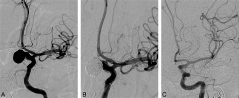 Superior Hypophyseal Artery Aneurysms Have The Lowest Recurrence Rate