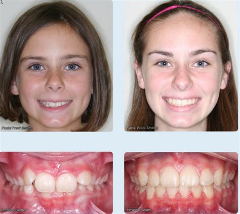 Before and After - Rodriguez Orthodontics | Hialeah FL