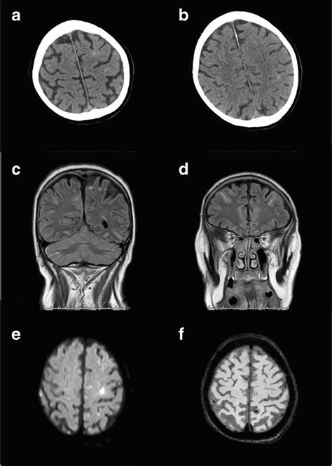 Non Aneurysmal SAH Co Existent With COVID 19 MRI In Patient A A F