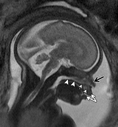 Mr Imaging Of The Fetal Face Comprehensive Review Radiographics