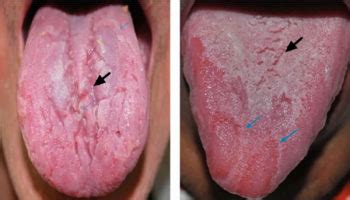 Fissured tongue causes, symptoms, diagnosis & fissured tongue treatment