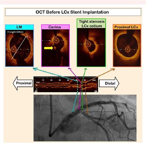 Optical coherence tomography before circumflex artery stent ...