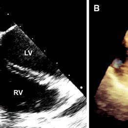 Transesophageal Echocardiography Of Tumor A Mid Esophageal 4 Chamber