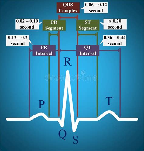 Qt Intervalo De Onda Eletrocardiográfica Ou Ecg Ou Ekg Ilustração Stock ...