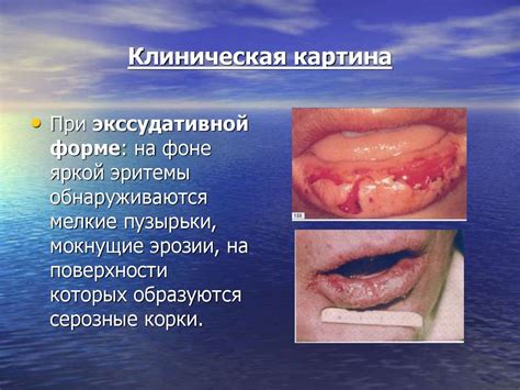 Хейлиты. Классификация хейлитов - презентация онлайн