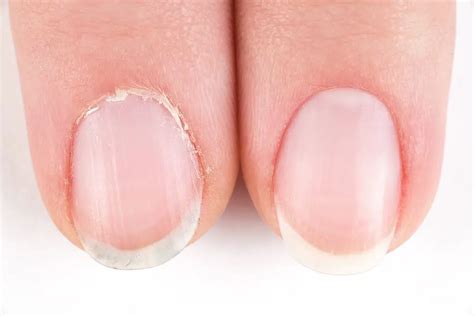 How To Heal Cuticles Overnight