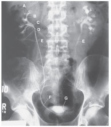 Retrograde Pyelogram (anatomy) Diagram | Quizlet