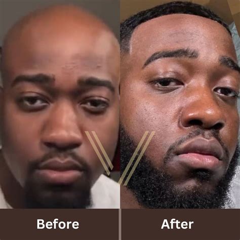 Jidion Hair Transplant Before And After Transformation