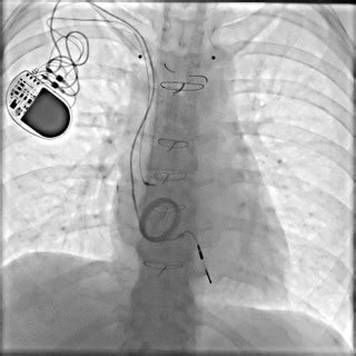 Extraction Of A Trapped Pacemaker Lead In A Pacemaker Dependent Patient