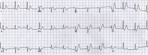 De Winter T Wave • LITFL • ECG Library Diagnosis