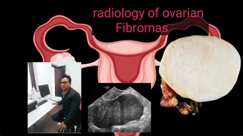 Radiology Of Ovarian Fibromas। Youtube