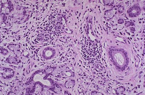 Sjögren Syndromesjogren Syndrome Stepwards