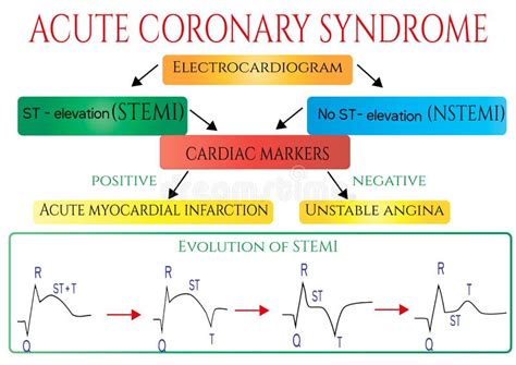 Akut Koronar Syndrom Schematisk Elektrokardiogram Av Myocardial Infarction Hjärta Attack Stock