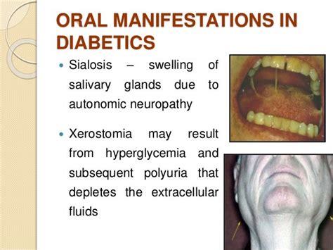 Oral Manifestations Of Systemic Diseases