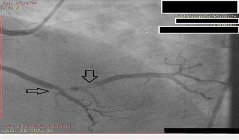 Angiogram of RCA showing severe (80-90%) blockage with complete ...