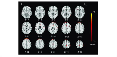 Results Of Main Effect Of Sex Brain Regions Influenced By Main Download Scientific Diagram