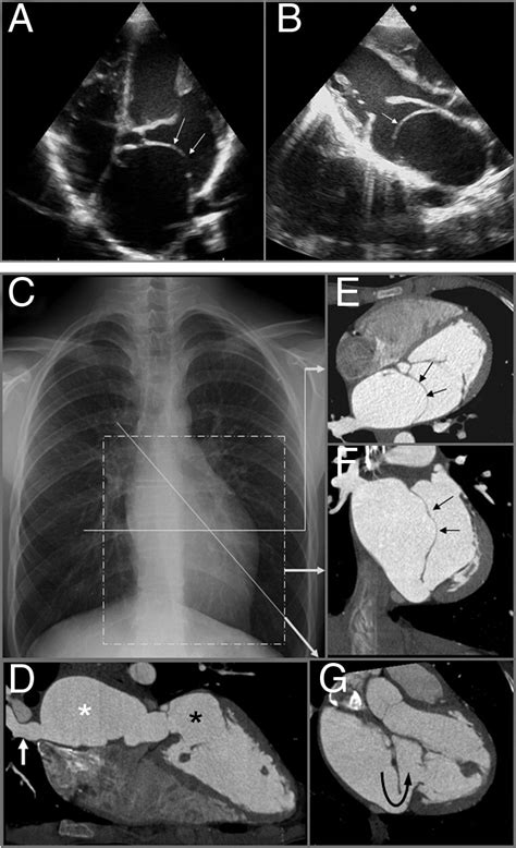 Cor Triatriatum Sinister A Comprehensive Anatomical Study On Computed