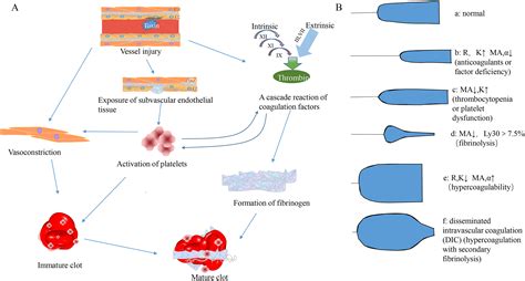 Clinical Application Of Thromboelastography In Acute Ischemic Stroke