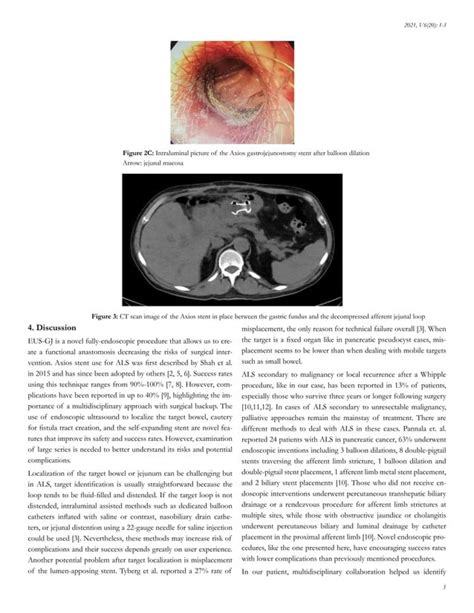 Endoscopic Ultrasound Guided Gastrojejunostomy Stent Placement A Novel Technique To Manage