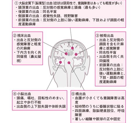 脳ヘルニアの症状