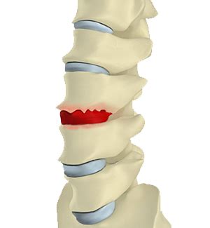 Bone Spur (Osteophytes) | Boca Raton Spine Center