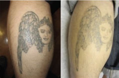 Safe & Effective Tattoo Removal | Frontier Dermatology