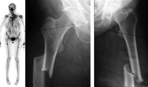 Atypical Femoral Fractures And Bisphosphonate Treatment Bone And Joint