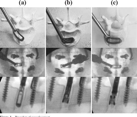 Figure 1 From Comparison Of Transforaminal Lumbar Interbody Fusion Using The Boomerang Shaped