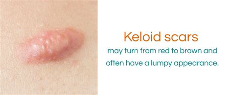 Hypertrophic Scar Removal Keloid Treatment Premier Clinic