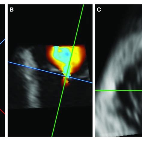 Example Of 3D Doppler VC Area Using Multiplanar Reconstruction A B