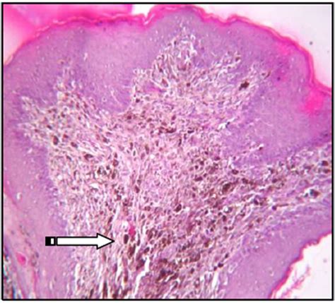 Figure 5b Arrow Mark Indicates Vertical Growth Pattern Of Melanocytes