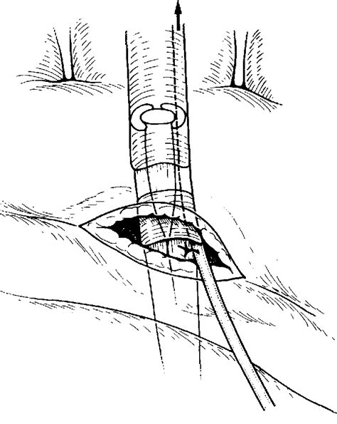 Figure 3 From Retrieval Of The Retracted Flexor Tendon Semantic Scholar