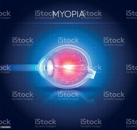 gangguan penglihatan miopia ilustrasi stok  gambar