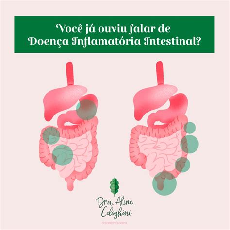 Divertículos Cólicos Sem Sinais Inflamatórios - O que são os divertículos? - Dra. Aline Celeghini Coloproctologista