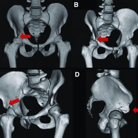 PDF Arthroscopic Decompression Of A Type III Subspine Impingement