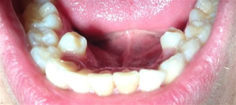 Supernumerary Teeth Definition, Causes, and Treatment - Healthrow.net