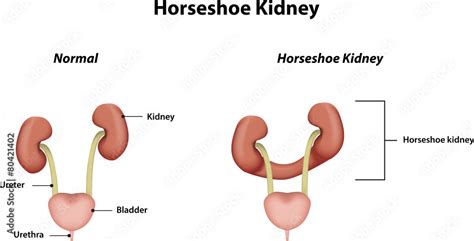 Horseshoe Kidney Labeled Diagram Stock Illustration | Adobe Stock